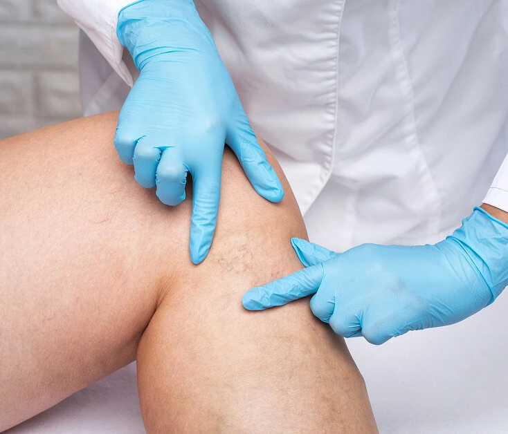 A vein specialist examines visible varicose veins at a Boca Raton vein center.