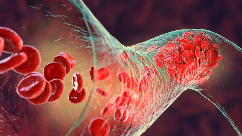 Illustration of blood clot blocking a vein, showing vein disease and need for treatment.